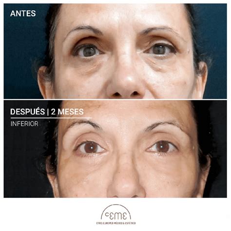 blefaroplastia antes y despues